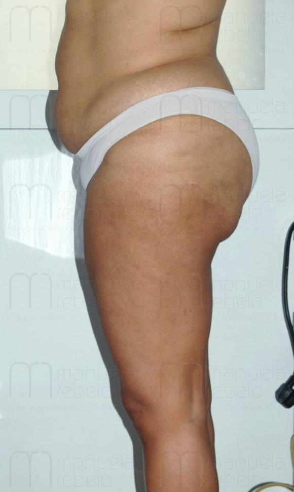 Depois do tratamento